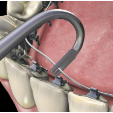 DIRECTEUR DE LIGATURES LINGUAL EN FORME DE U HU-FRIEDY 678-707